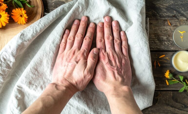 Natural Skincare for Eczema: What Actually Works?