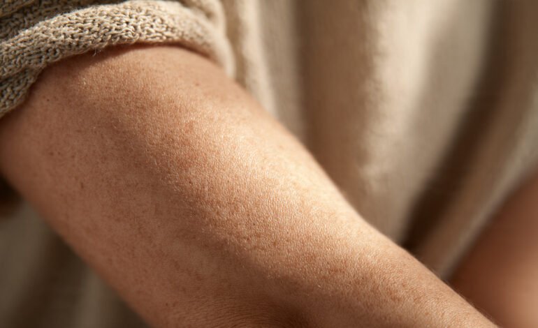 Close-up of dry sensitive skin being gently moisturised with natural balm texture symbolising eczema relief